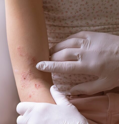 Dermatologist examining eczema