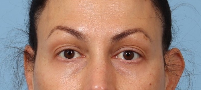woman after sylfirm treatment