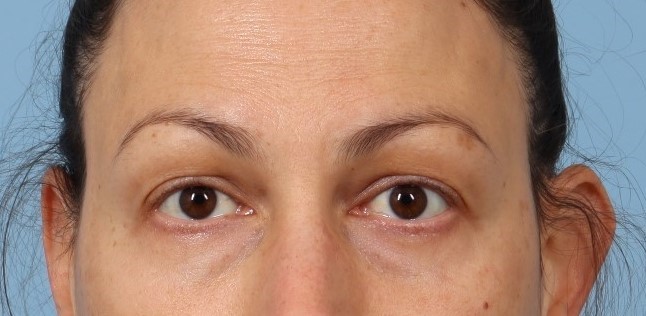 woman before Sylfirm treatment