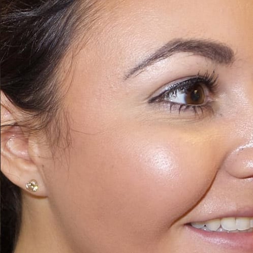 pinski botox 14 after