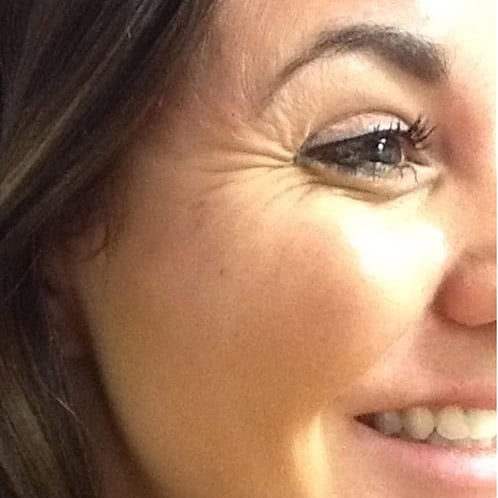 pinski botox 14 before