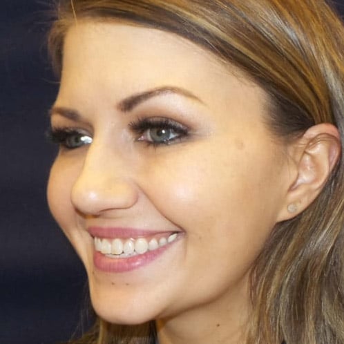 pinski botox 20 after