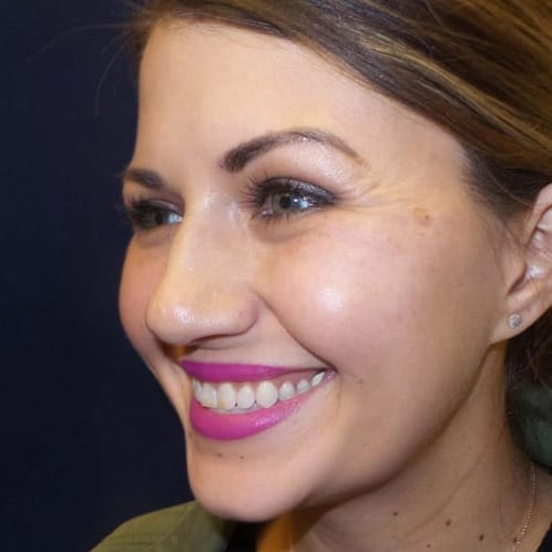 pinski botox 20 before