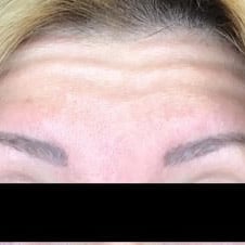 pinski botox 25 before