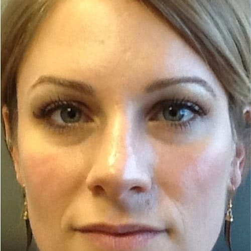 pinski botox 6 after