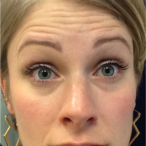 pinski botox 6 before