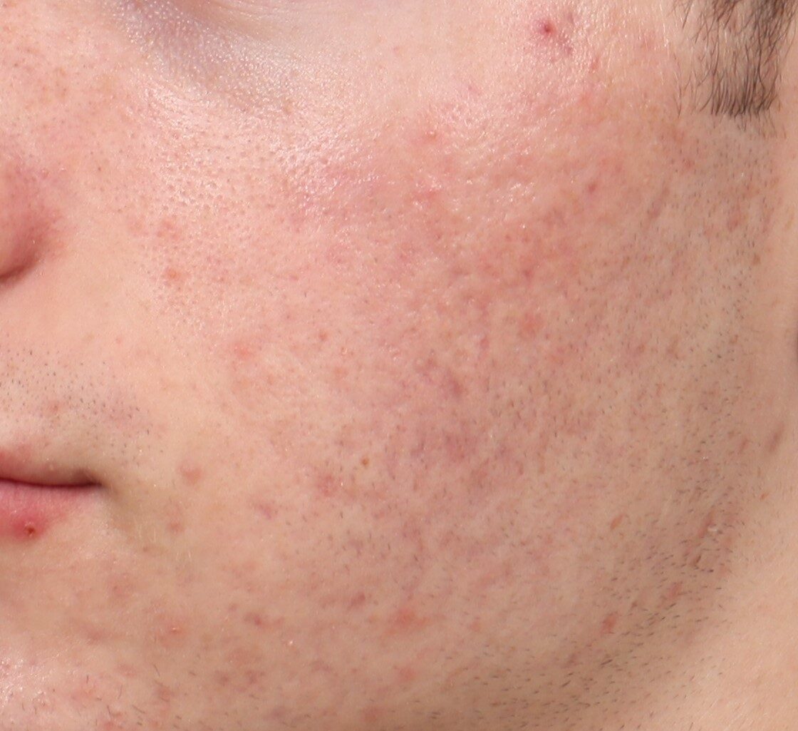 AviClear results Dermatology + Aesthetics Chicago