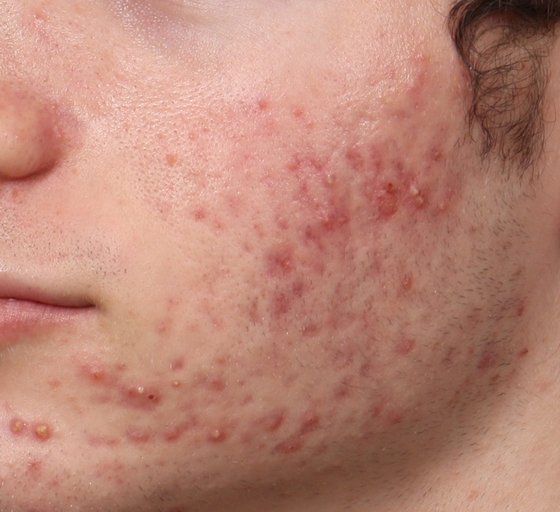 AviClear Results Dermatology + Aesthetics Chicago
