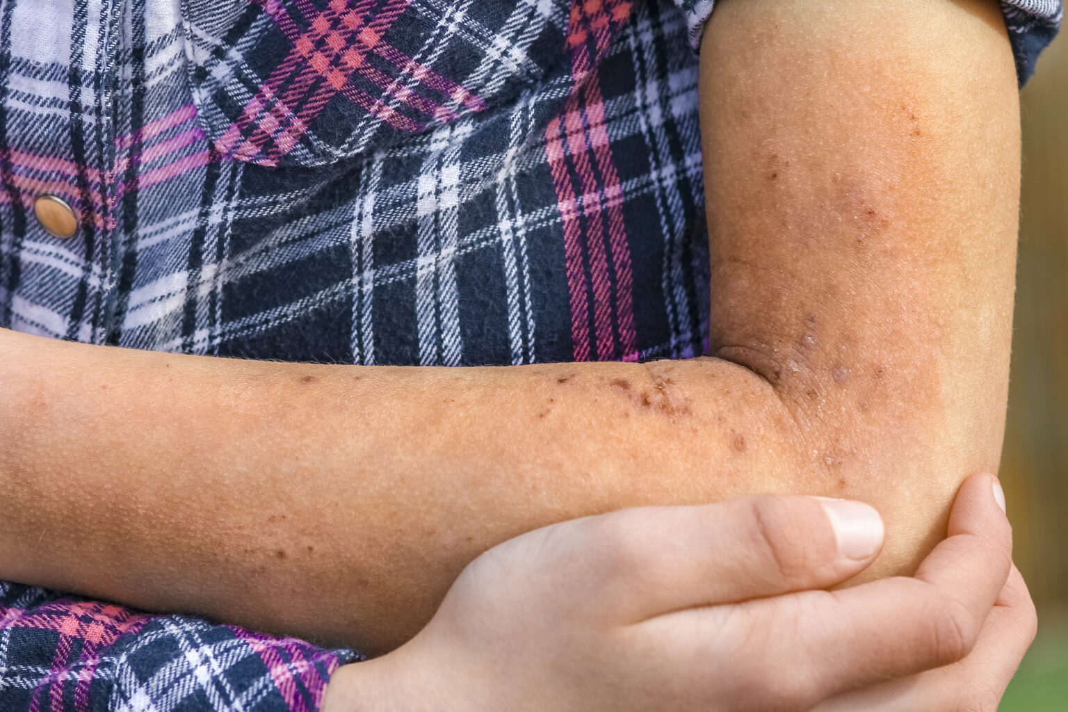 Un niño con dermatitis de contacto