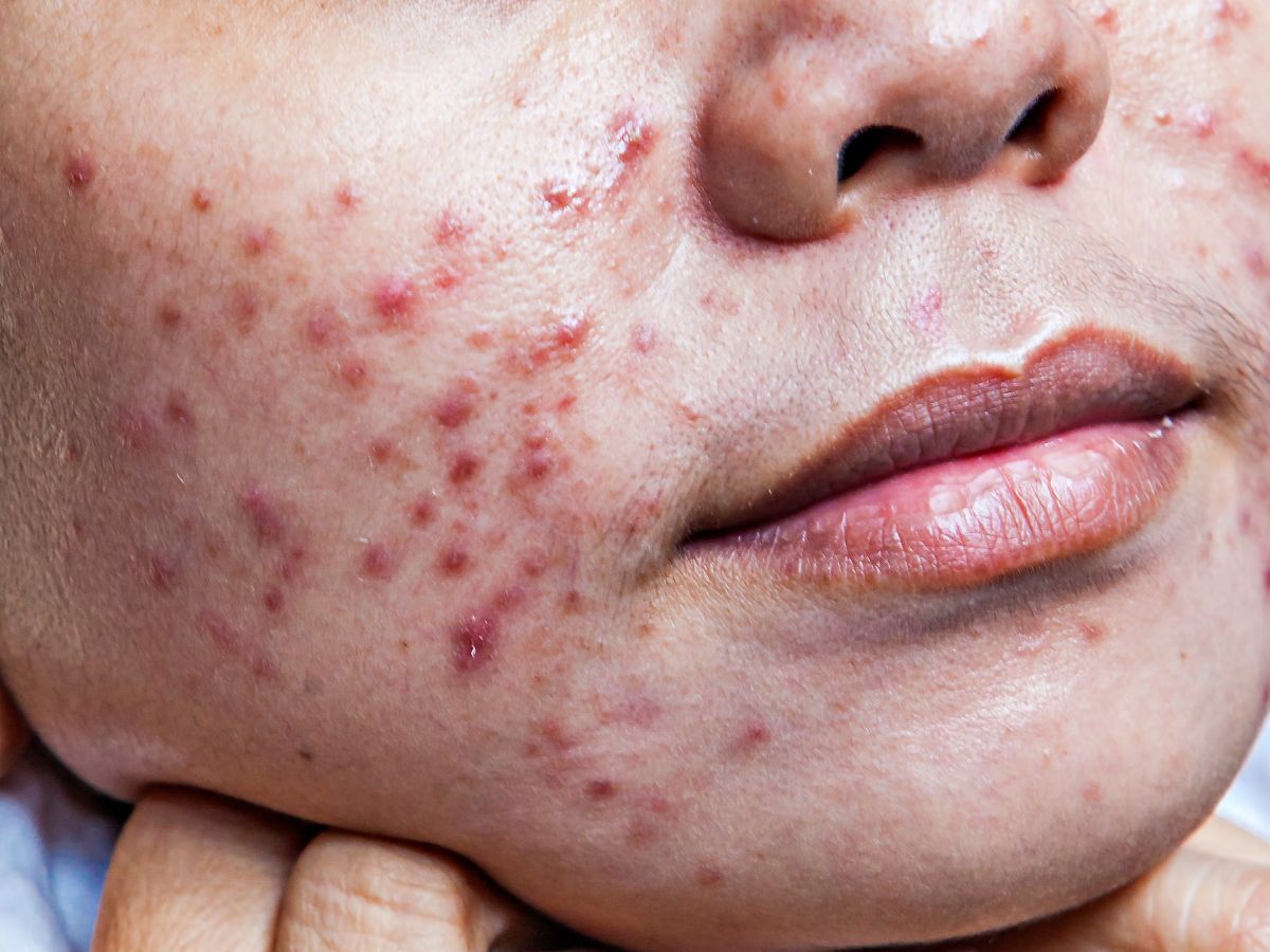 Cystic Acne 