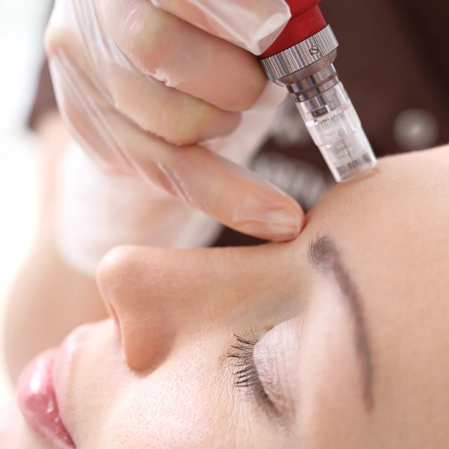 microneedling treatment woman image